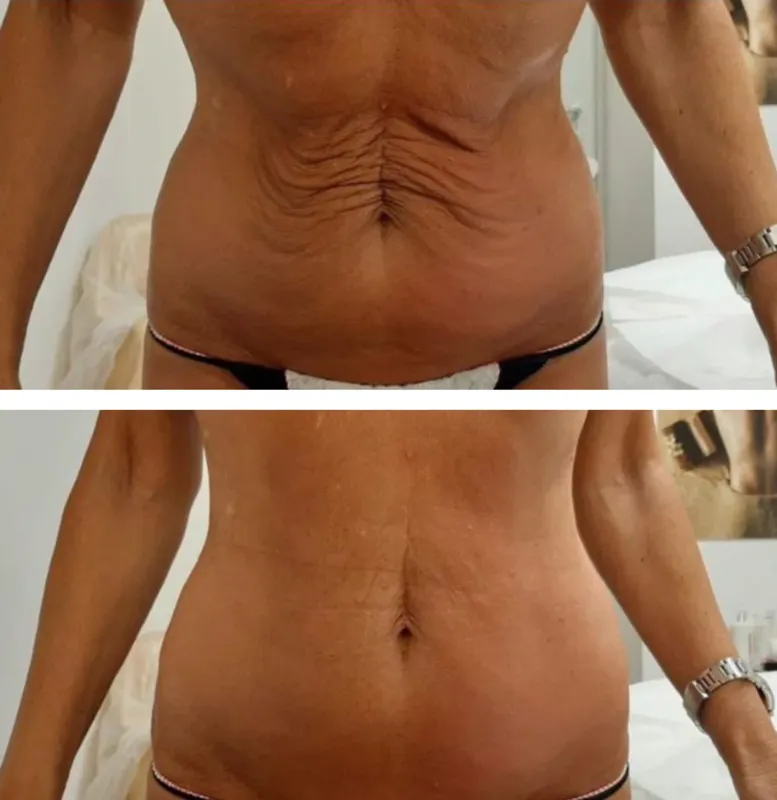 Before and after, abdomen, device manufacturer photo