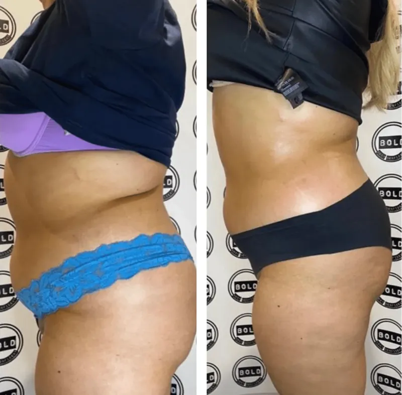 Before and after, flanks, device manufacturer photo